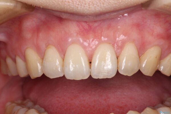 矯正治療で退縮してしまった歯肉　歯肉移植で自然な前歯に 治療後画像