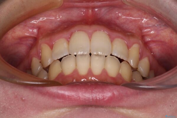 捻れた前歯をインビザラインでスッキリと 治療後画像