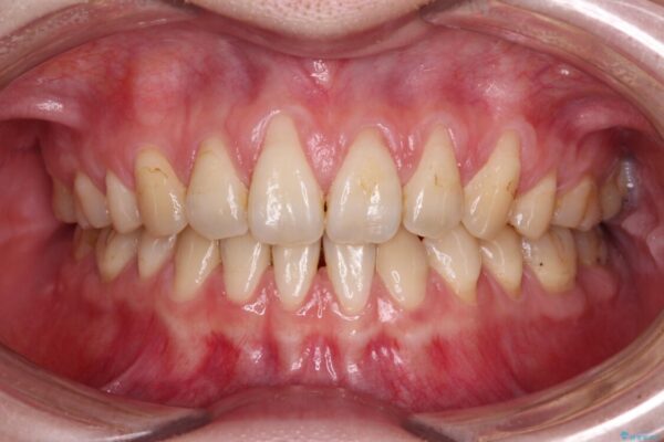 矯正治療で退縮してしまった歯肉　歯肉移植で自然な前歯に 治療前画像