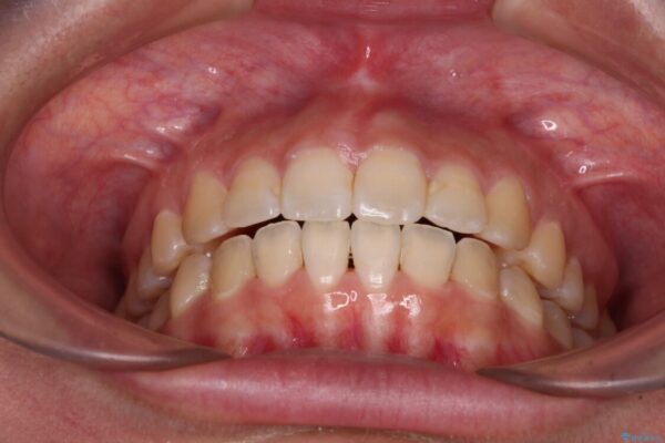 【モニター】カリエールディスタライザーとインビザラインを用いた奥歯の咬み合わせ改善 治療後画像