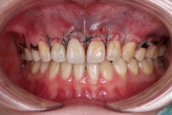矯正治療で退縮してしまった歯肉　歯肉移植で自然な前歯に 治療途中画像