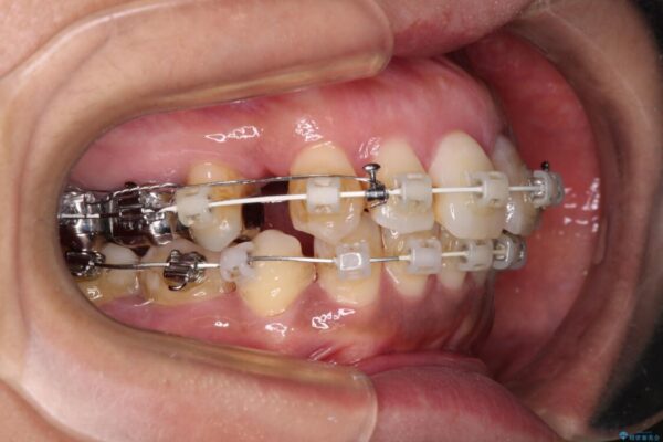 内側に倒れた前歯と口元の突出感　ワイヤー装置での抜歯矯正 治療途中画像