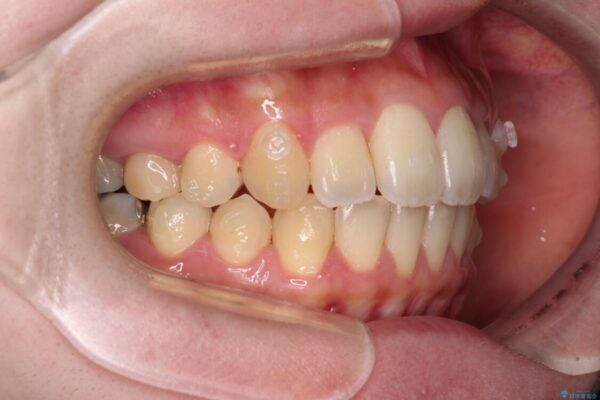 捻れた前歯をインビザラインでスッキリと 治療途中画像