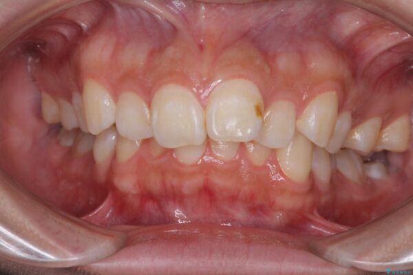 上顎前突による口元の突出感　強く深い咬合をワイヤー矯正で改善していく 治療前画像