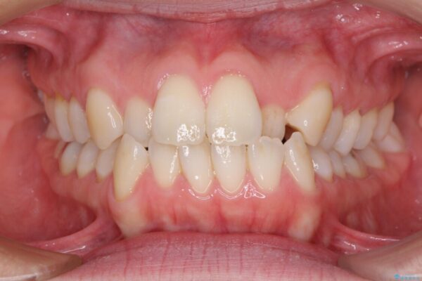 受け口傾向の歯並びをインビザラインで改善 ビフォー