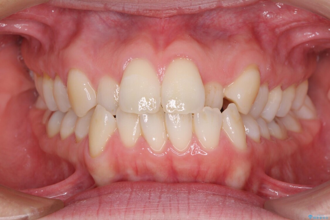 受け口傾向の歯並びをインビザラインで改善 治療前