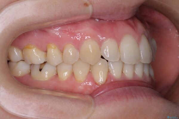 受け口傾向の歯並びをインビザラインで改善 治療後画像