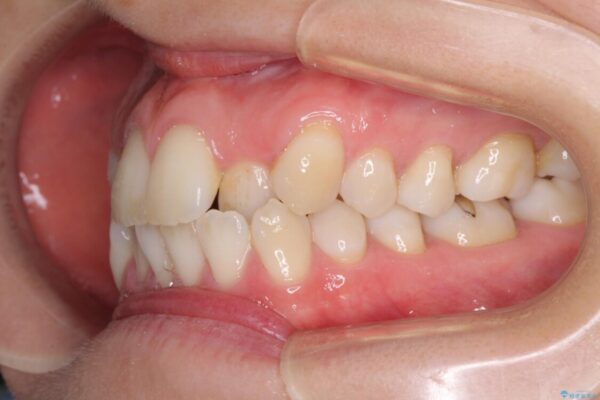 受け口傾向の歯並びをインビザラインで改善 治療前画像