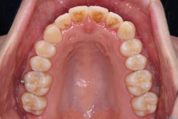 受け口傾向の歯並びをインビザラインで改善 治療途中画像