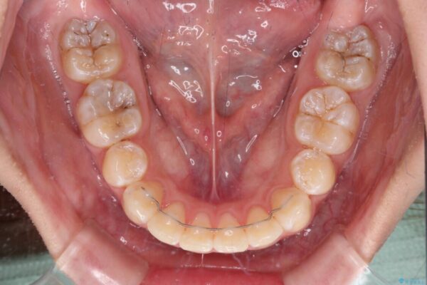 上顎前突による口元の突出感　強く深い咬合をワイヤー矯正で改善していく 治療後画像