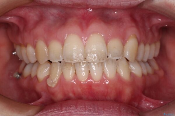 受け口傾向の歯並びをインビザラインで改善 治療途中画像