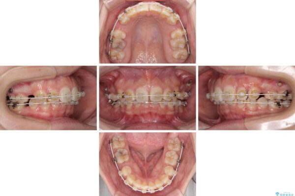 上顎前突による口元の突出感　強く深い咬合をワイヤー矯正で改善していく 治療途中画像