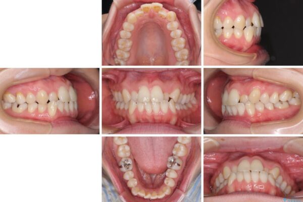 受け口傾向の歯並びをインビザラインで改善 治療前画像