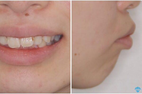 上顎前突による口元の突出感　強く深い咬合をワイヤー矯正で改善していく 治療前画像