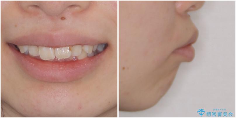 上顎前突による口元の突出感　強く深い咬合をワイヤー矯正で改善していく 治療前
