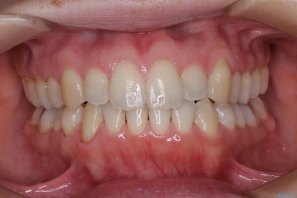 受け口傾向の歯並びをインビザラインで改善 治療後画像