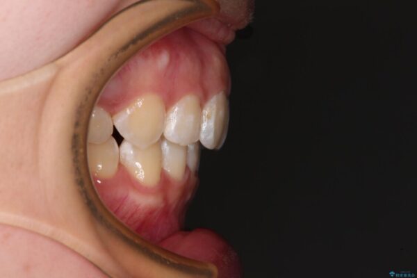 上顎前突による口元の突出感　強く深い咬合をワイヤー矯正で改善していく 治療後画像