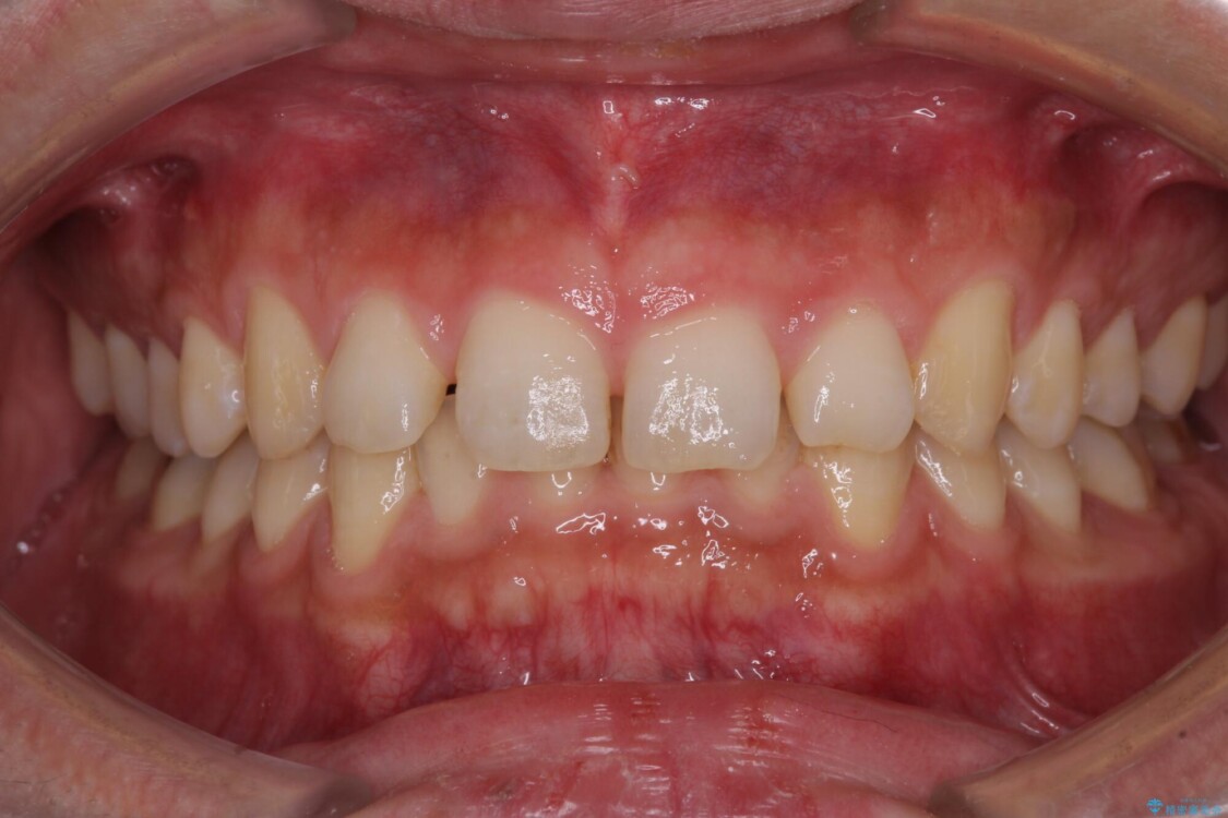 深い咬み合わせと隙間の空いた歯列をワイヤー矯正で改善 治療前