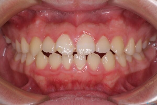 舌突出癖で隙間の空いてしまう歯列　舌トレーニングを行ったインビザライン矯正 ビフォー