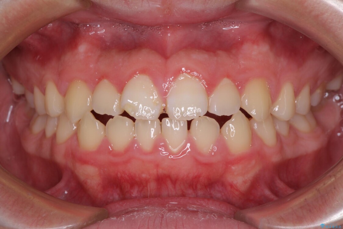 舌突出癖で隙間の空いてしまう歯列　舌トレーニングを行ったインビザライン矯正 治療前