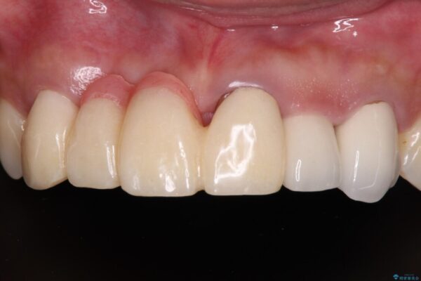 長く見える歯を治したい　歯肉移植による歯肉増大術 ビフォー