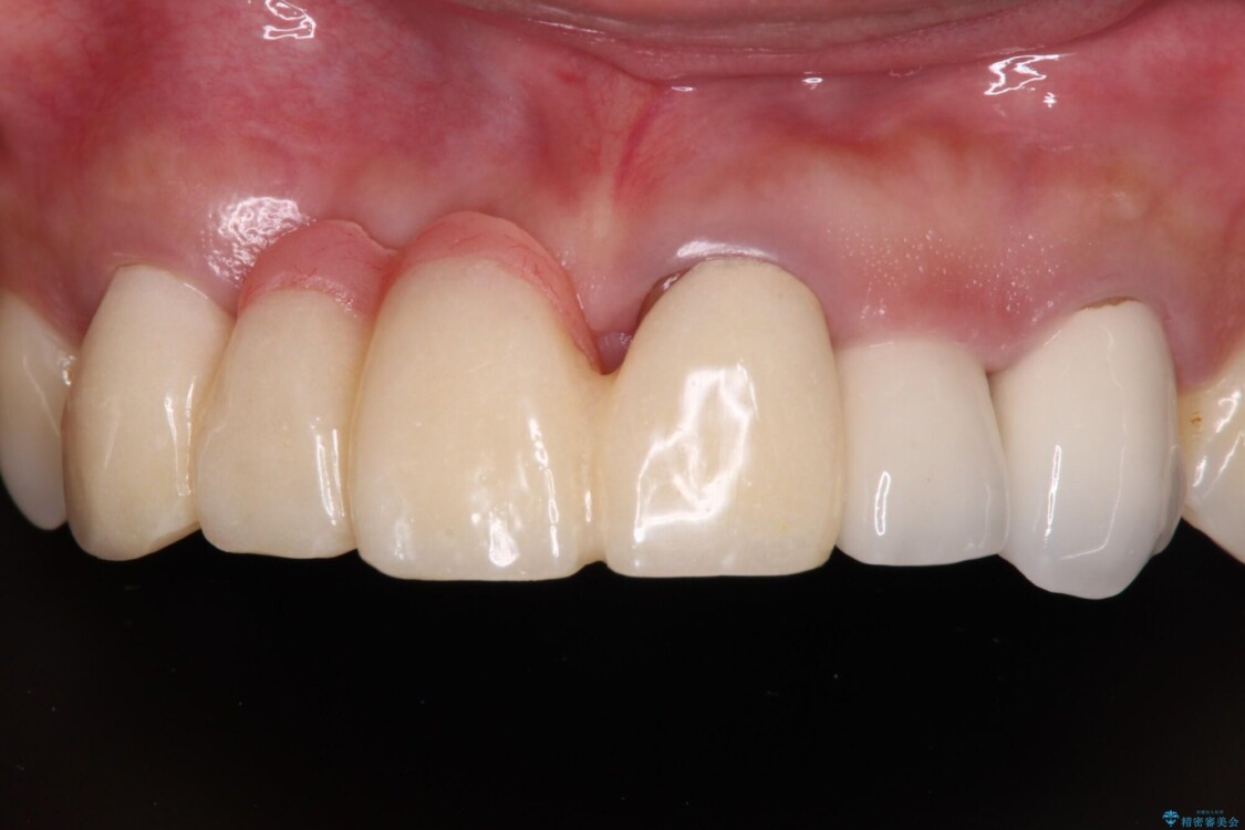長く見える歯を治したい　歯肉移植による歯肉増大術 治療前