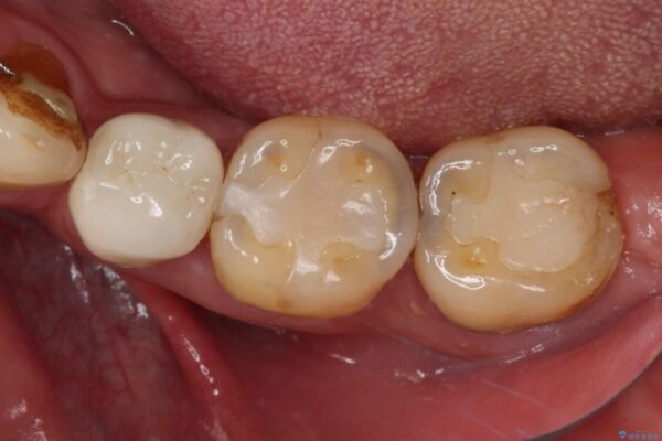 痛みの続く大きな虫歯の奥歯　オールセラミッククラウンでの補綴治療 ビフォー