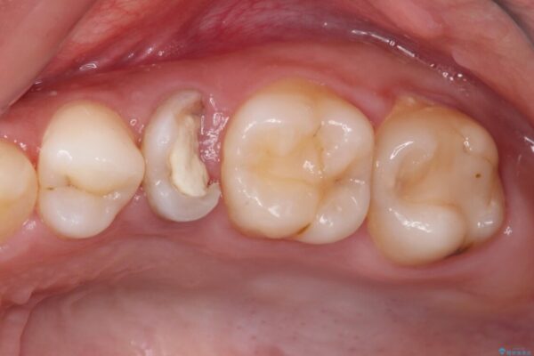 抜歯と言われた歯を残したい　部分矯正と外科処置を用いた補綴治療 ビフォー