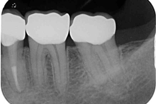 痛みの続く大きな虫歯の奥歯　オールセラミッククラウンでの補綴治療 治療後画像