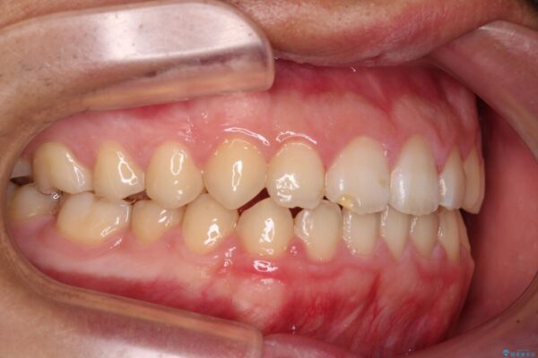 舌突出癖で隙間の空いてしまう歯列　舌トレーニングを行ったインビザライン矯正 治療後画像