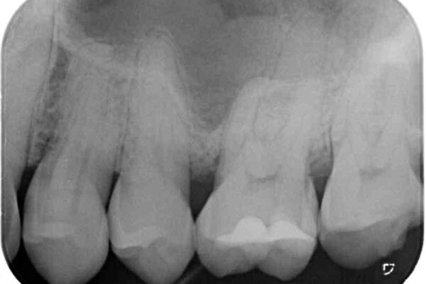 食事で割れてしまった奥歯　外科処置を用いた補綴治療 治療前画像
