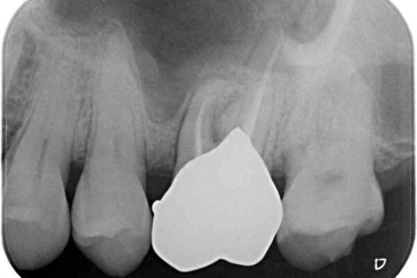 食事で割れてしまった奥歯　外科処置を用いた補綴治療 治療後画像