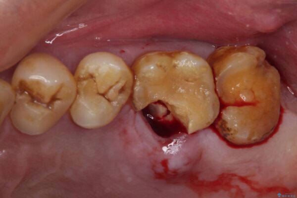 食事で割れてしまった奥歯　外科処置を用いた補綴治療 治療後画像