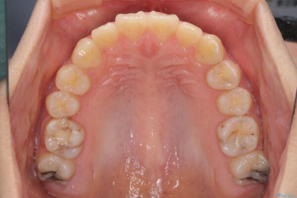 目立たない装置で出っ歯を治したい　ハーフリンガル矯正 治療前画像