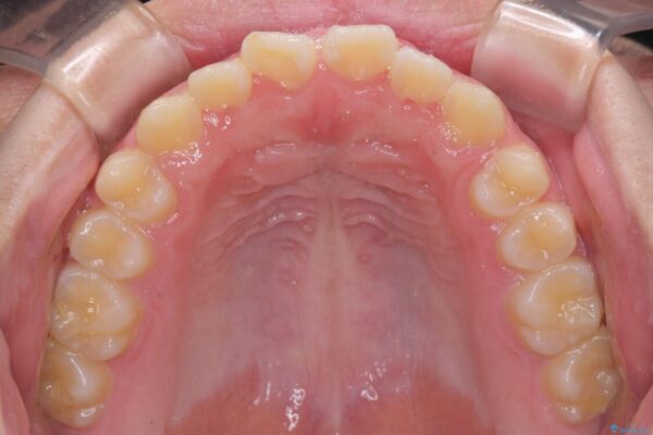 舌突出癖で隙間の空いてしまう歯列　舌トレーニングを行ったインビザライン矯正 治療前画像