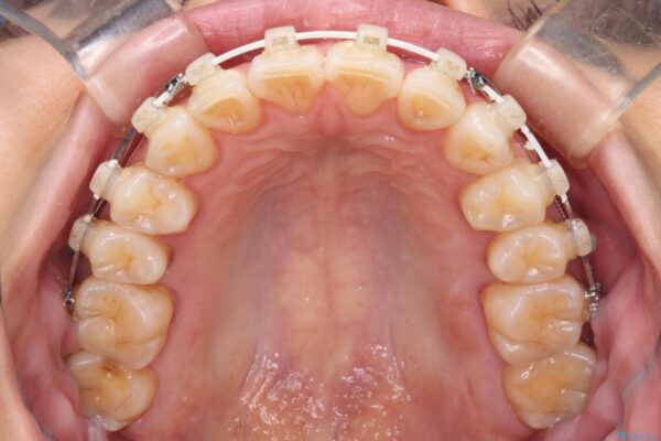前にずれた咬み合わせをワイヤー装置でしっかりと改善 治療途中画像