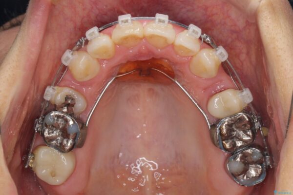 閉じにくい口元と欠損歯列　ワイヤー装置の抜歯矯正 治療途中画像
