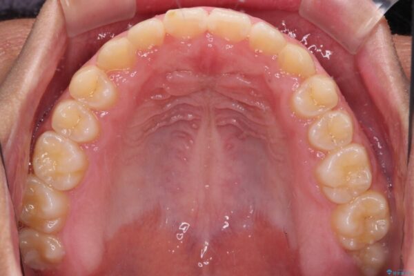 舌突出癖で隙間の空いてしまう歯列　舌トレーニングを行ったインビザライン矯正 治療途中画像
