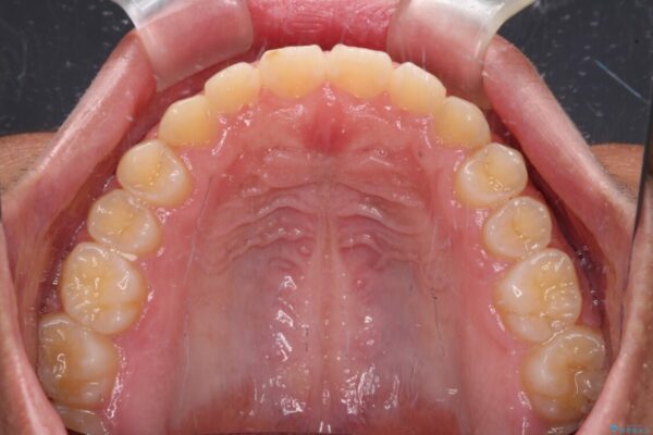 舌突出癖で隙間の空いてしまう歯列　舌トレーニングを行ったインビザライン矯正 治療後画像