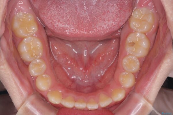 舌突出癖で隙間の空いてしまう歯列　舌トレーニングを行ったインビザライン矯正 治療前画像