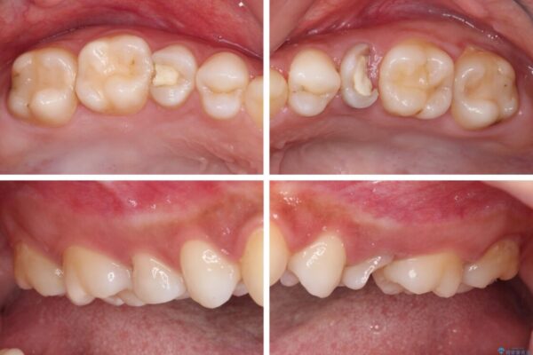 抜歯と言われた歯を残したい　部分矯正と外科処置を用いた補綴治療 治療前画像