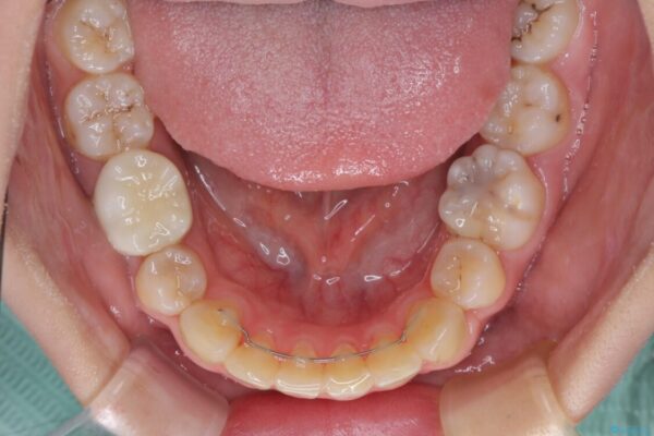目立たない装置で出っ歯を治したい　ハーフリンガル矯正 治療後画像
