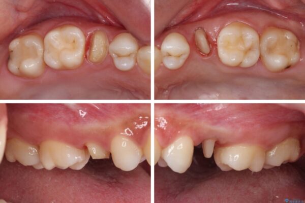 抜歯と言われた歯を残したい　部分矯正と外科処置を用いた補綴治療 治療途中画像