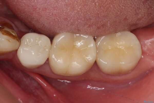 痛みの続く大きな虫歯の奥歯　オールセラミッククラウンでの補綴治療 アフター