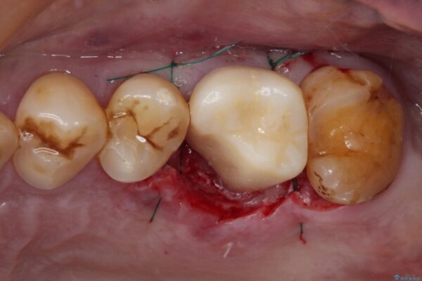 食事で割れてしまった奥歯　外科処置を用いた補綴治療 治療途中画像
