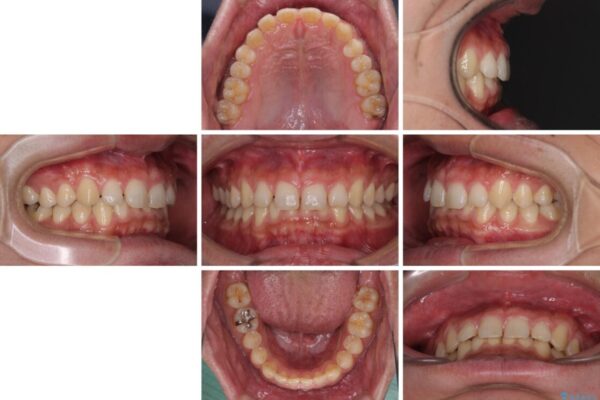 深い咬み合わせと隙間の空いた歯列をワイヤー矯正で改善 治療前画像