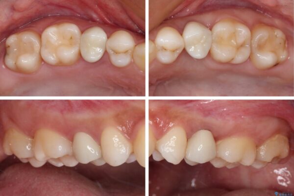 抜歯と言われた歯を残したい　部分矯正と外科処置を用いた補綴治療 治療後画像