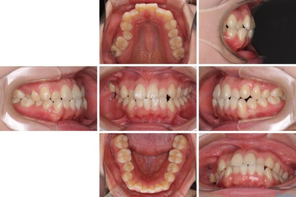 反対咬合とクロスバイトを改善して噛みやすい咬合に 治療前画像