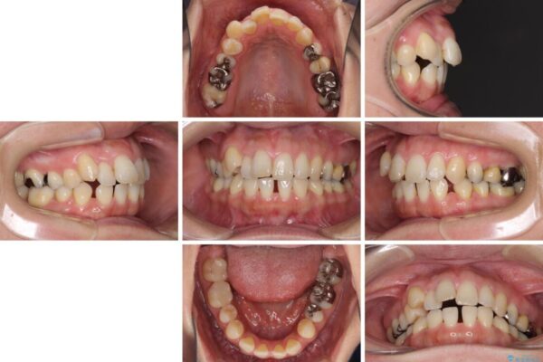 閉じにくい口元と欠損歯列　ワイヤー装置の抜歯矯正 治療前画像