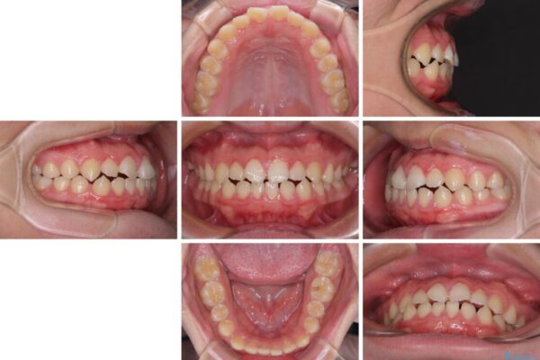 舌突出癖で隙間の空いてしまう歯列　舌トレーニングを行ったインビザライン矯正 治療前画像